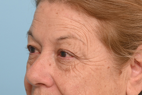 Patient 26708 Blepharoplasty Before After Photos