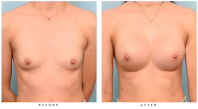 Breast Augmentation Before and After | Dr. Tyler Frew MD