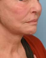 Facial Fat Transfer