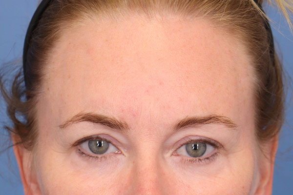 Brow Lift