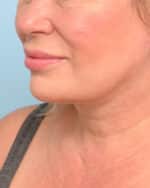 Facial Fat Transfer