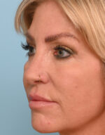 Rhinoplasty