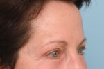 Brow Lift