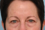 Brow Lift