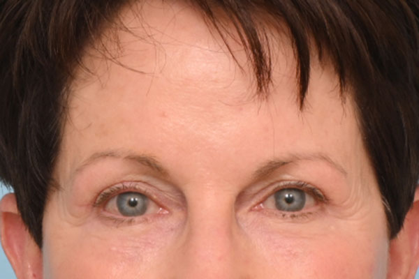 Brow Lift