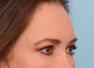 Brow Lift