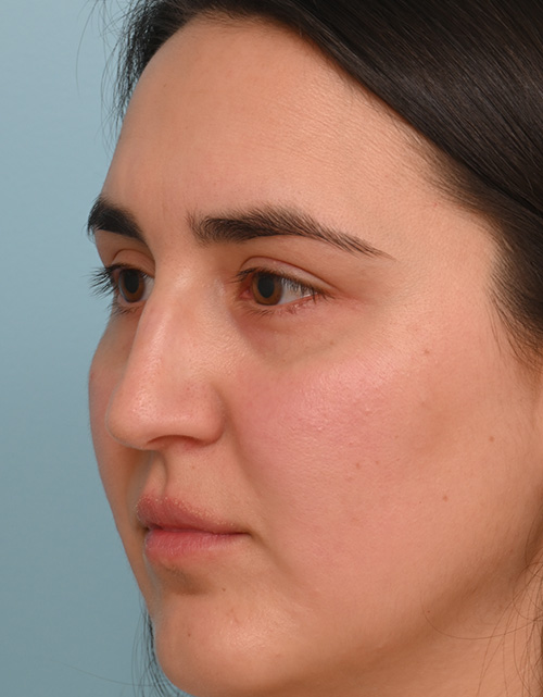 Rhinoplasty