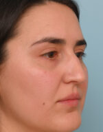 Rhinoplasty