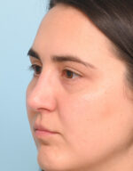 Rhinoplasty