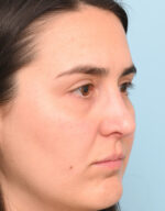 Rhinoplasty