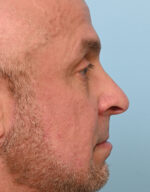 Rhinoplasty