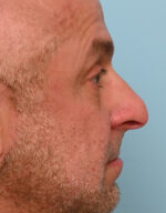 Rhinoplasty