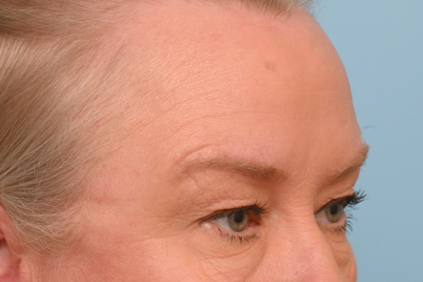 Brow Lift