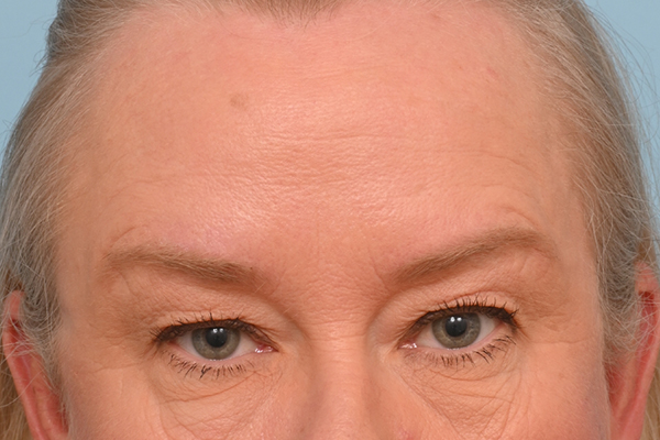 Brow Lift