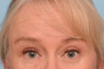 Brow Lift