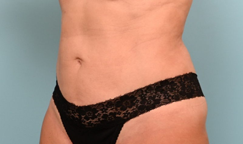 Body Liposuction