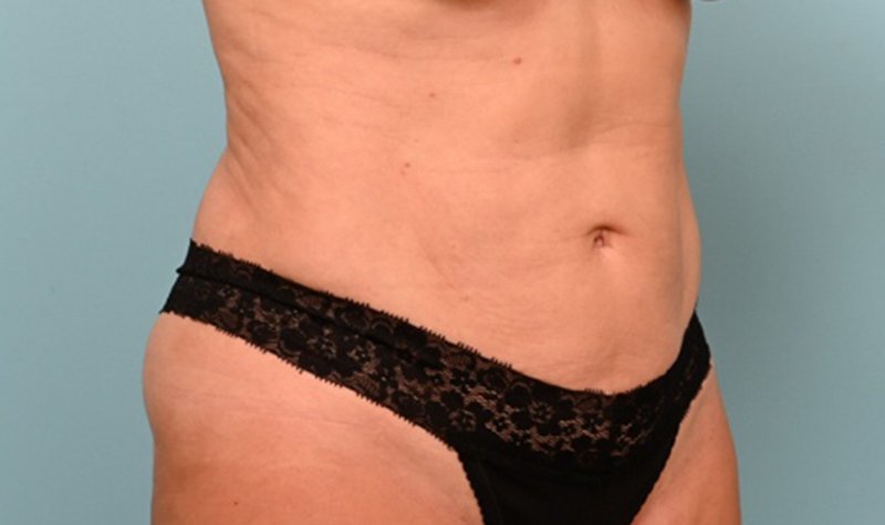 Body Liposuction