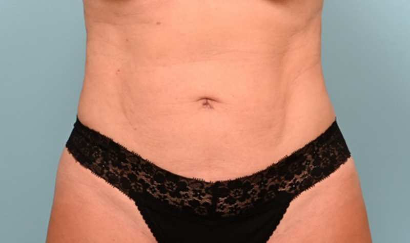 Body Liposuction