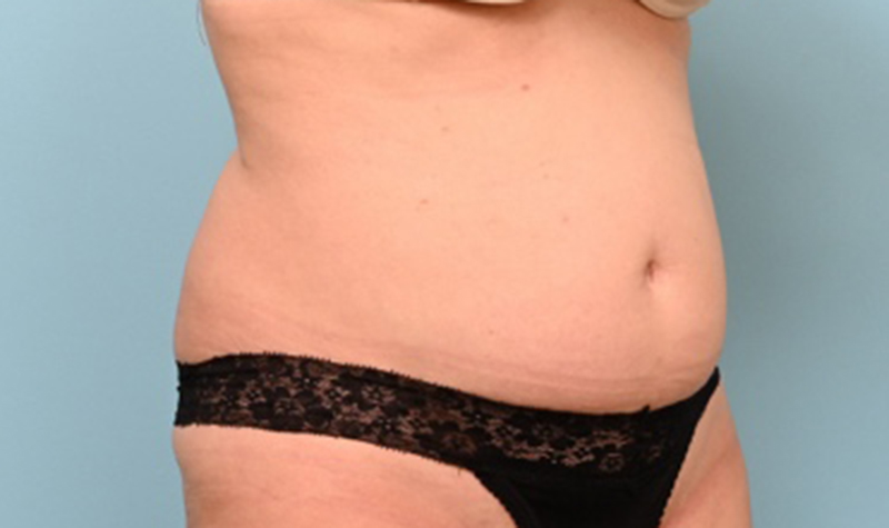 Body Liposuction