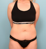 Tummy Tuck