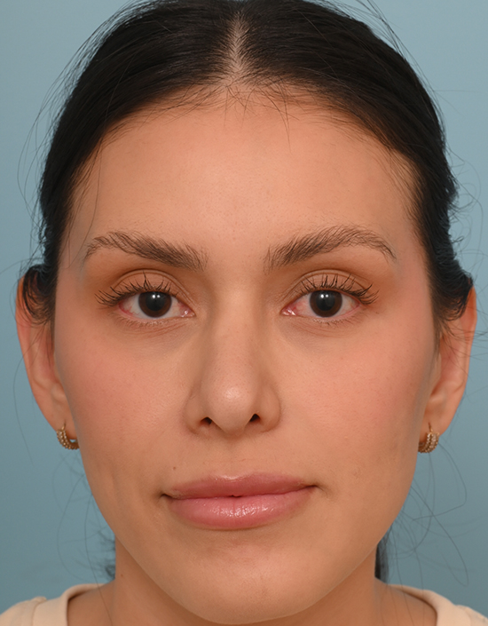 Rhinoplasty