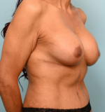 Breast Lift