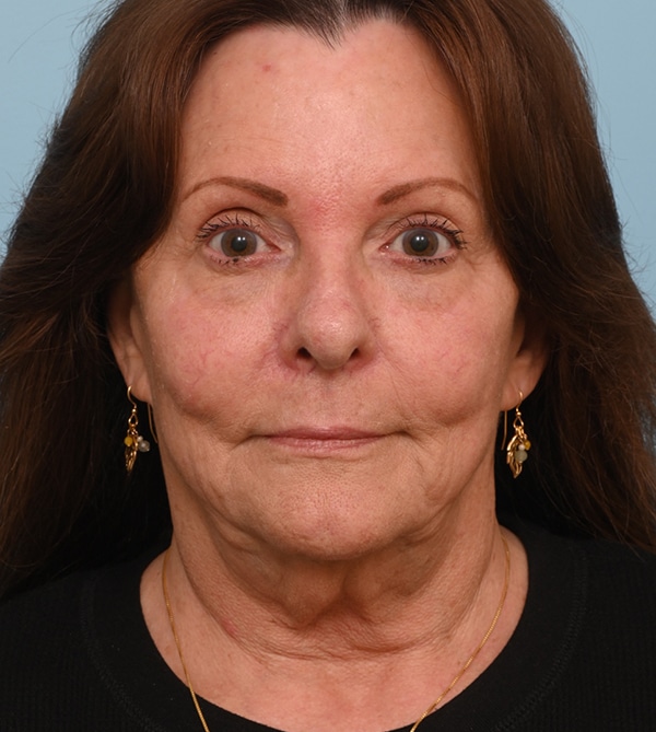 Patient Facelift Results Before After Photos