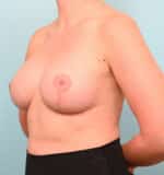 Breast Lift