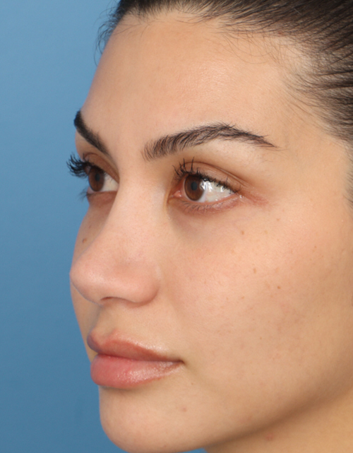 Rhinoplasty