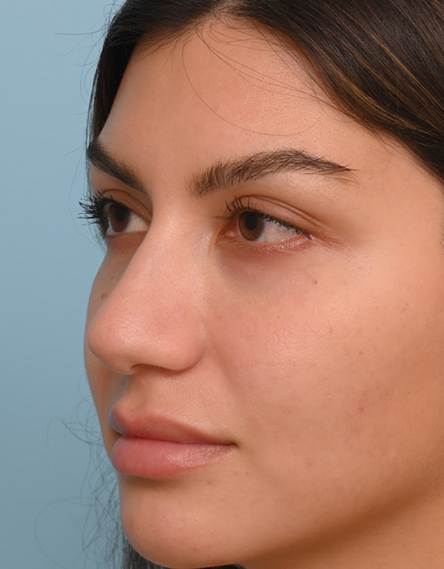 Rhinoplasty